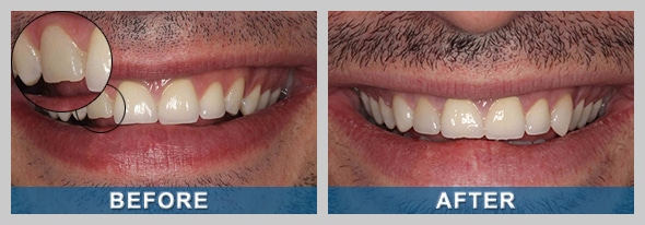 Cosmetic Dentistry Before and After Photo