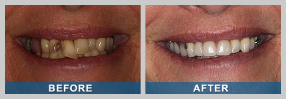 Dentures Before and After Treatment