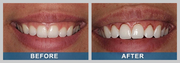 Laser Before and After Treatment