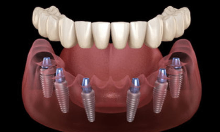 All on 4 dental implants benefits