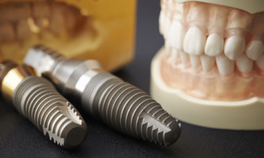 Tips to care for dental implants