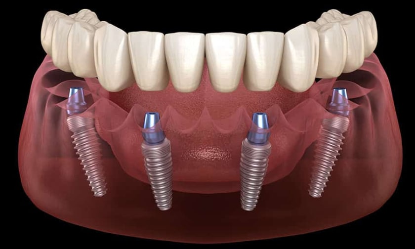 All-On-4 Dental Implants: A Breakthrough For The Future Of Dentistry